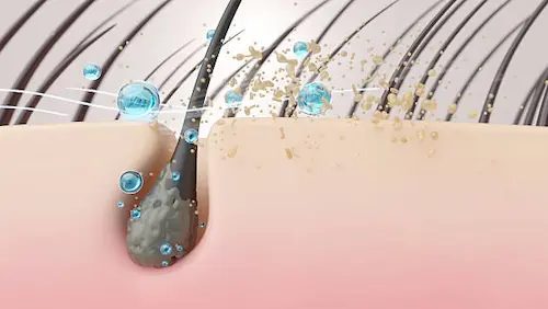 The "Greasy Root" Fix